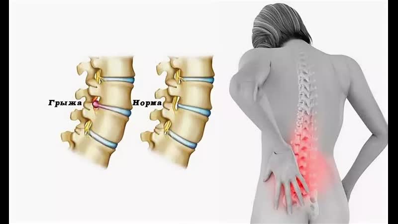 بررسی جراحی بسته دیسک کمر | درمان دیسک کمر اصفهان