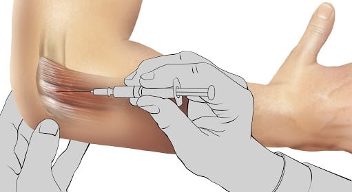تزریق اوزون | درمان دیسک کمر اصفهان