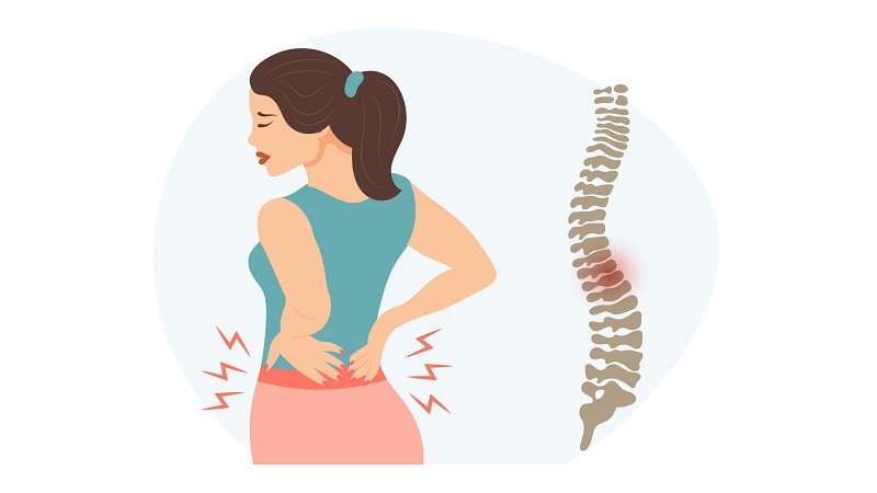 علل تشدید دیسک کمر | درمان دیسک کمر اصفهان | دکتر امیر قنبریان