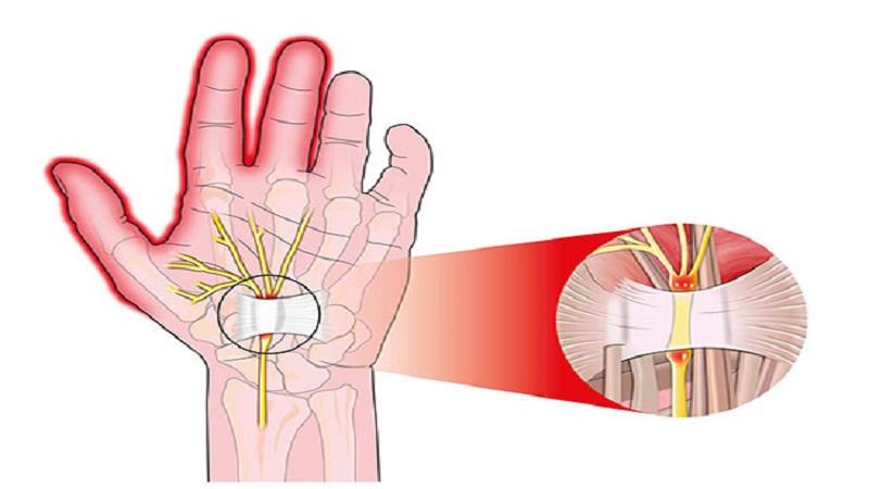 بررسی سندروم تونل کارپال (CTS) | درمان دیسک کمر اصفهان