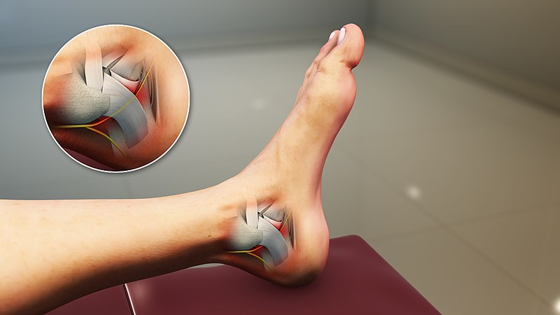 علل سندروم تونل تارسال مچ پا | درمان دیسک کمر اصفهان