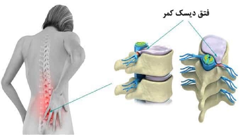 علل و تشخیص بیرون زدگی دیسک کمر | درمان دیسک کمر اصفهان