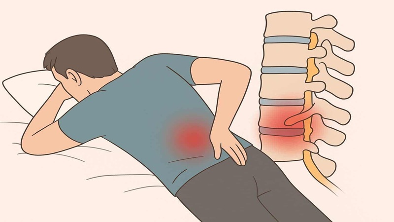 علائم دیسک کمر | درمان دیسک کمر اصفهان | دکتر امیر قنبریان