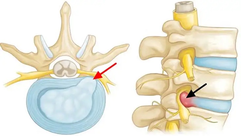 تفاوت دیسک کمر با سیاتیک | درمان دیسک کمر اصفهان | دکتر امیر قنبریان