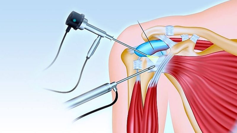 عوارض و خطرات جراحی آرتروسکوپی مفصل زانو | درمان دیسک کمر اصفهان