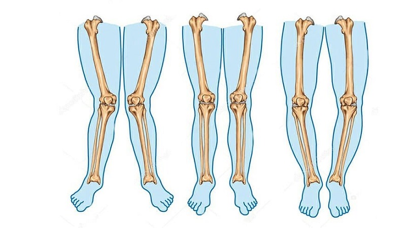 تفاوت پای پرانتزی و زانوی ضربدری | درمان دیسک کمر اصفهان