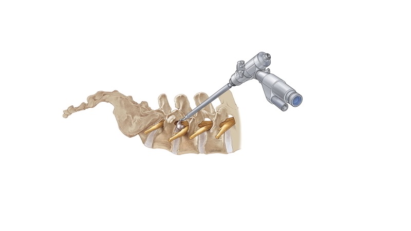 دکتر امیر قنبریان | درمان دیسک کمر اصفهان