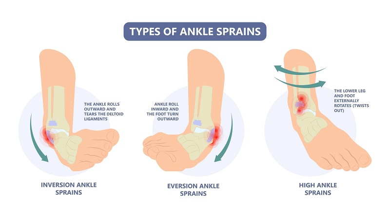 خطرات چرخش مچ پا به داخل | درمان دیسک کمر اصفهان | دکتر امیر قنبریان