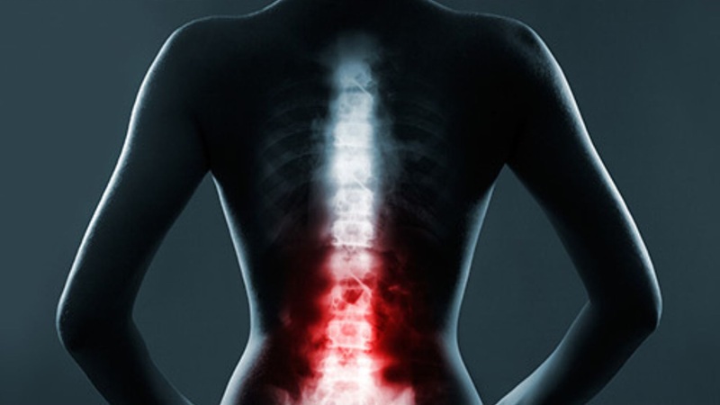 علل تشدید دیسک کمر | درمان دیسک کمر اصفهان | دکتر امیر قنبریان