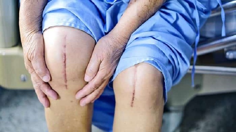 علت درد پس از جراحی تعویض مفصل زانو | درمان دیسک کمر اصفهان