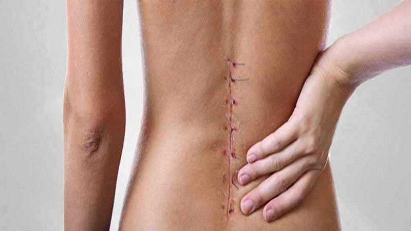 عوارض جراحی دیسک کمر | درمان دیسک کمر اصفهان
