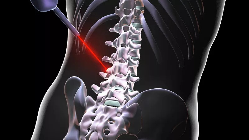 درمان دیسک کمر اصفهان | دکتر امیر قنبریان